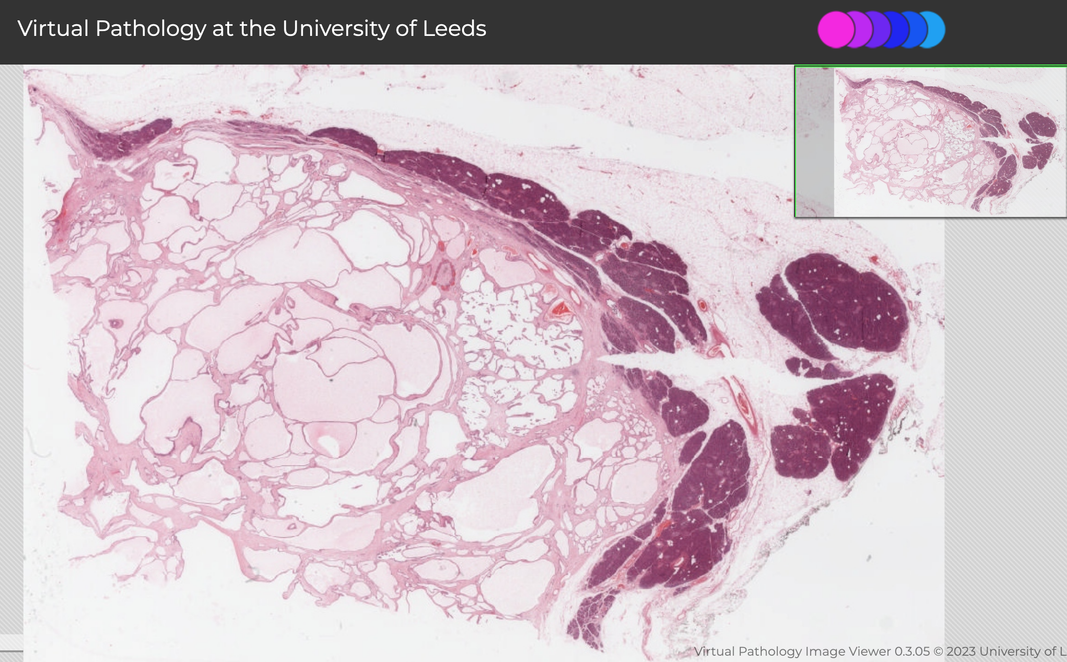 Microcystic Serous Cystadenoma